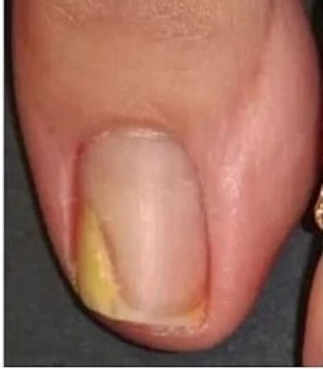 nokat na nozi s gljivicama prije tretmana