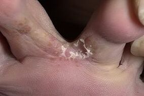 simptomi gljivica na stopalima