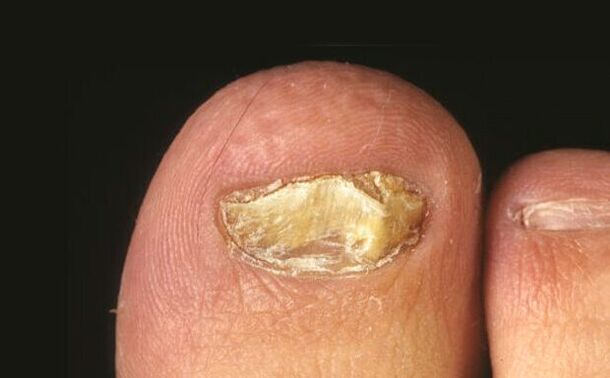 gljivica noktiju na nogama