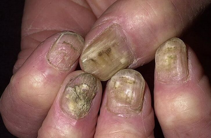 Deformacija, odvajanje i mrvljenje noktiju zbog gljivica