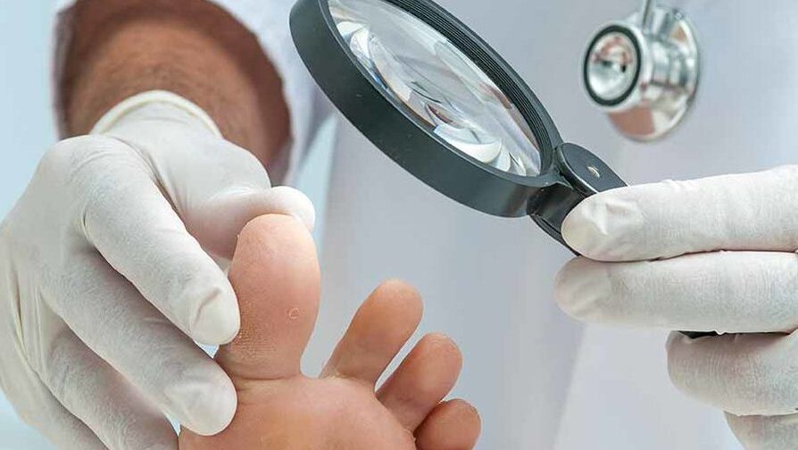 Dijagnostiku gljivica na noktima nogu provodi dermatolog