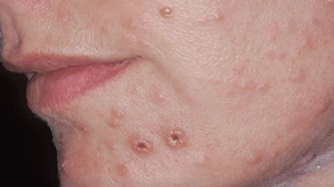 Gljivična infekcija kože na licu