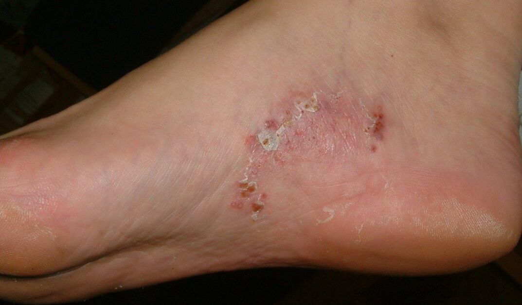 Manifestacije gljivične infekcije na stopalu